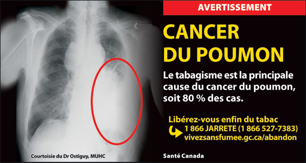 Canada 2012 Health Effects lung - xray, lung cancer - cigar fr